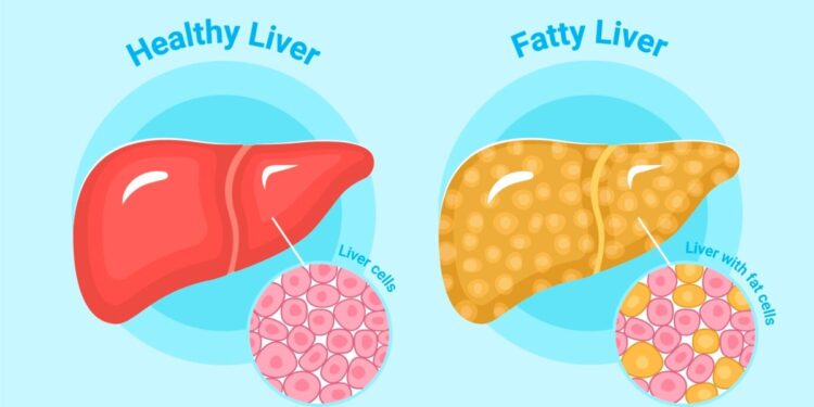 ફેટી લિવરને કારણે સ્વાસ્થ્ય સંબંધી અનેક ગંભીર સમસ્યાઓ થાય છે, જાણો અંગને કેવી રીતે સ્વસ્થ રાખવું