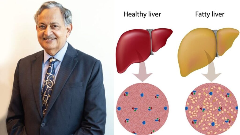 શું ફેટી યકૃત સિરોસિસમાં પરિણમી શકે છે? પ્રગતિને કેવી રીતે ટાળવી તે વિશે નિષ્ણાતનો અભિપ્રાય તપાસો